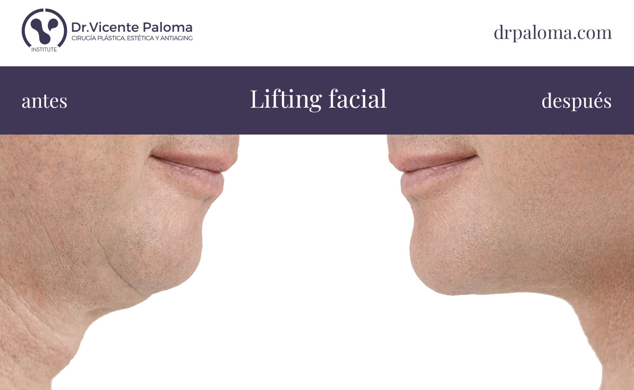 lifting facial antes y después