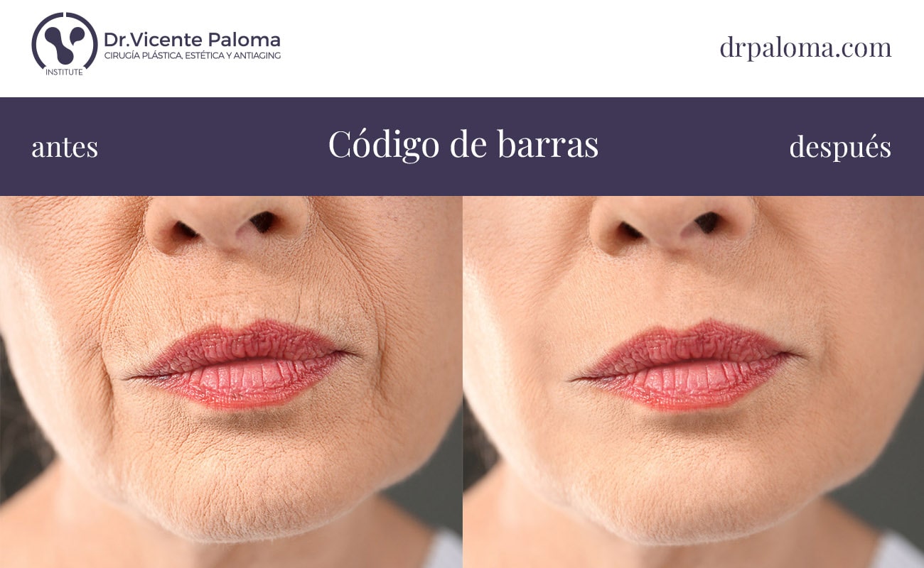 código de barras labios antes y después
