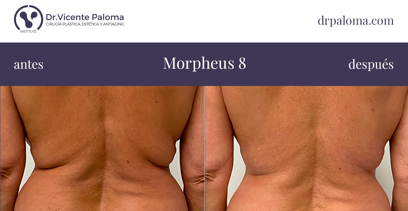 morpheus 8 antes y después abdomen