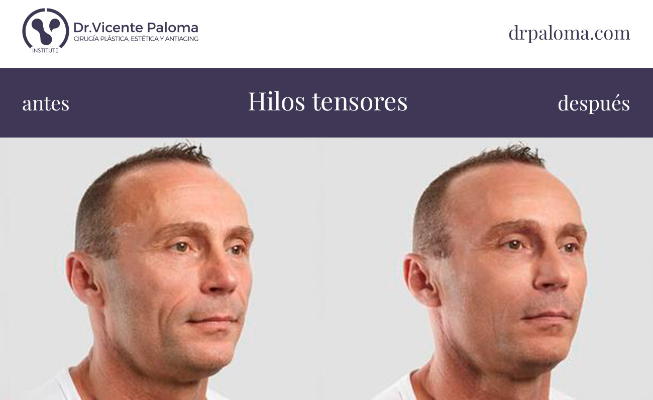 hilos tensores cara antes y despues