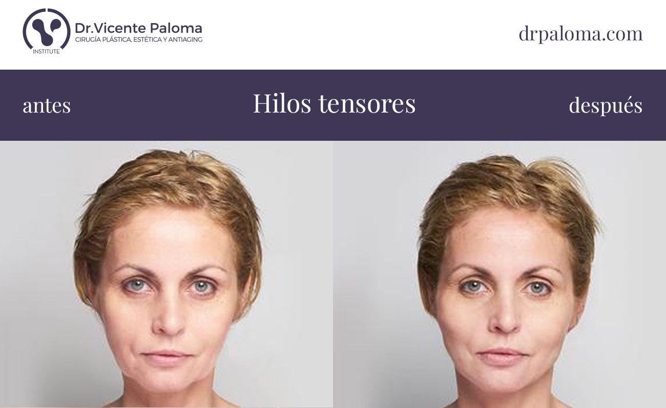 hilos tensores antes y despues